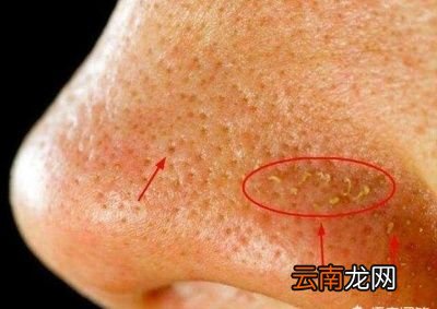 黑头里面挤出来的颗粒物是什么东西