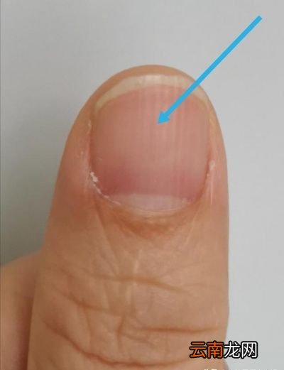 中医认为肝其华在于爪指甲有竖纹是肝不好吗