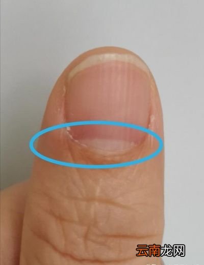 中医认为肝其华在于爪指甲有竖纹是肝不好吗
