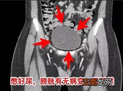 需要憋尿的超声检查有哪些