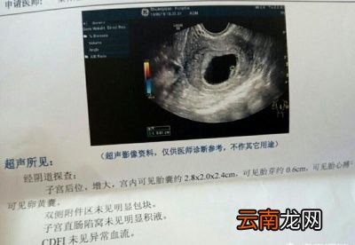 怀孕了次做B超孕妈应该做阴超还是腹超