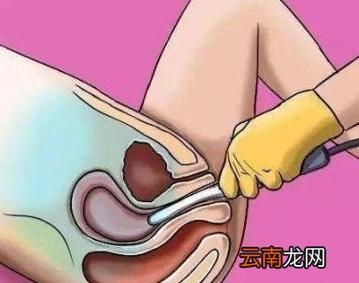 怀孕次做B超应该做阴超还是腹超