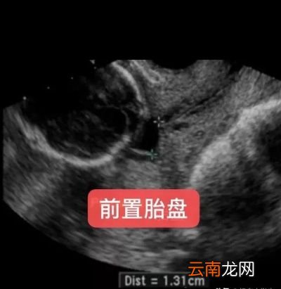 还有哪些产科产检需要做阴超