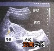 还有哪些产科产检需要做阴超