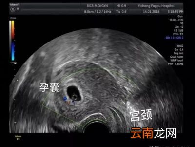 还有哪些产科产检需要做阴超