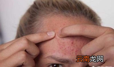 如何祛除脸上的螨虫