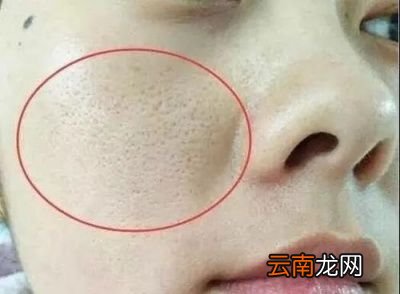 脸上有螨虫应该怎么除螨呢