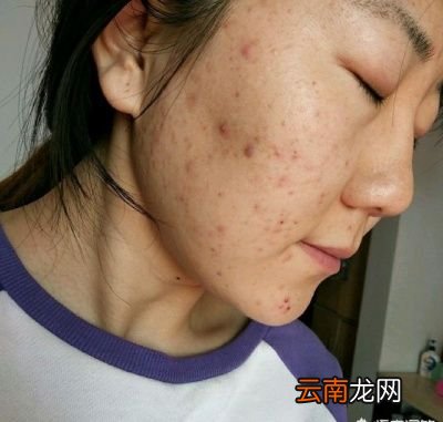 脸上有螨虫应该怎么除螨呢