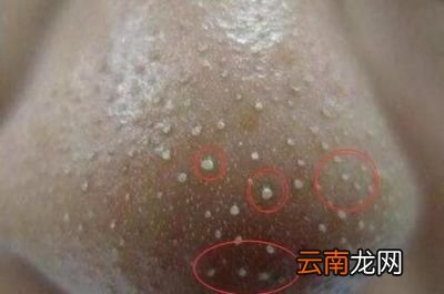 辨别脸上螨虫的4种方法