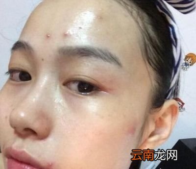 辨别脸上螨虫的4种方法