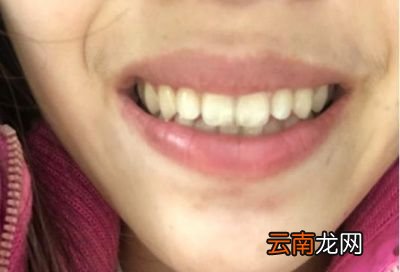 如何自测脸上螨虫多不多可以从这5方面观察