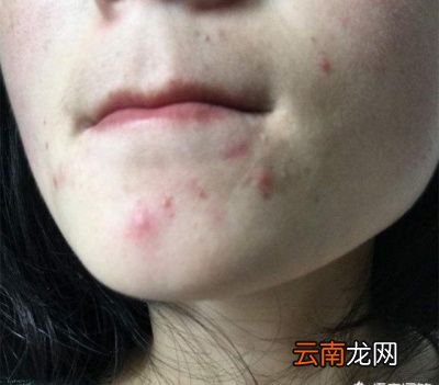 如何自测脸上螨虫多不多可以从这5方面观察