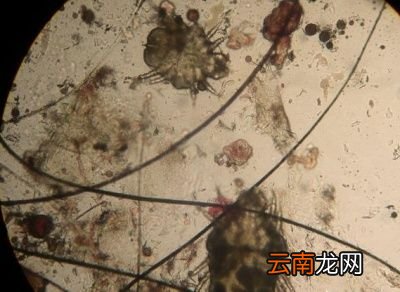 如何去除脸上螨虫恢复健康脸蛋