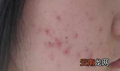 如何去除脸上螨虫恢复健康脸蛋