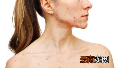 什么时候螨虫会变的有害呢