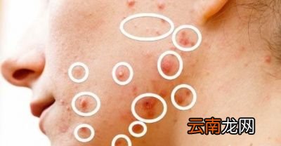 脸上大颗红肿的痘痘是螨虫痘吗