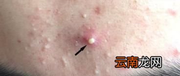 脸上大颗红肿的痘痘是螨虫痘吗