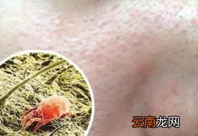 螨虫是什么对人体有什么危害吗