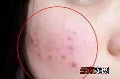 螨虫是什么对人体有什么危害吗