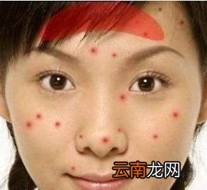 如何有效根治螨虫脸