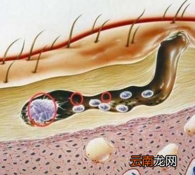 如何有效根治螨虫脸