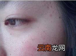 如何有效根治螨虫脸
