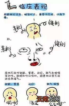 面瘫有哪些症状