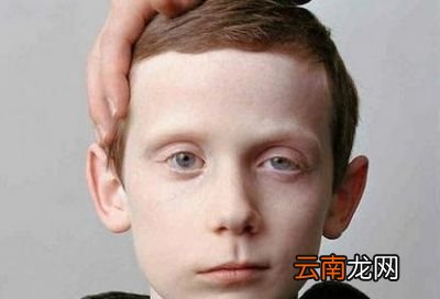 面瘫有哪些症状