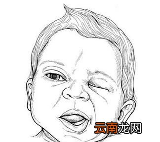 面瘫有哪些症状