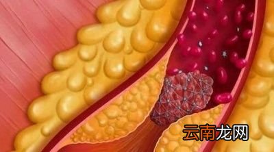 判断脑门长痘痘是不是体内湿气重的大致标准