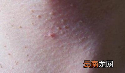小肉粒应该怎么去除