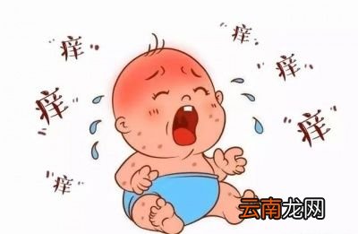 婴儿湿疹严重有必要把母乳停掉换水解奶粉吗