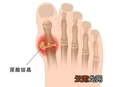 高尿酸血症患者饮食中要特别注意事项