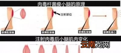 解决方法瘦腿针瘦小腿肚子+拉伸运动