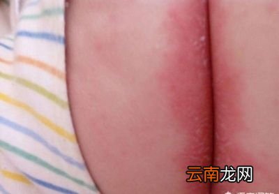 京妈建议怎么做可以预防宝宝出现红屁屁