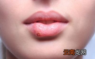 如果自己的嘴唇干裂了可以采取哪些方法补救