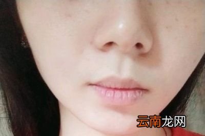 干裂嘴唇如何护理