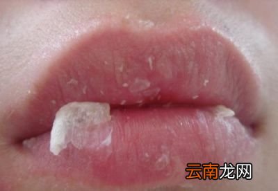 嘴唇经常性干裂和起皮这是什么原因