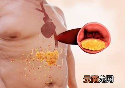 如何减掉啤酒肚