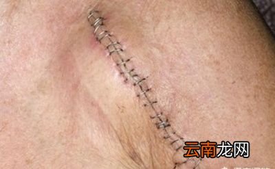 伤口处理时注意事项