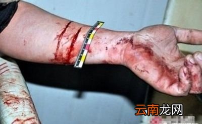 伤口处理时注意事项