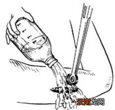 伤口处理时注意事项