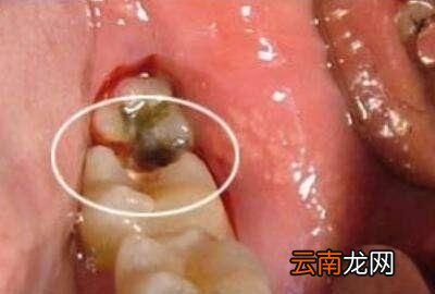 现在大招来啦预防蛀牙的方法有哪些往下看