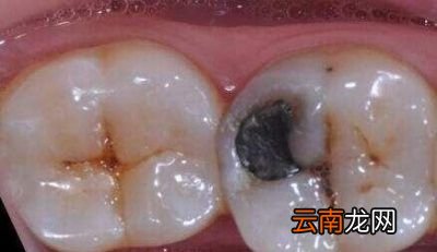 现在大招来啦预防蛀牙的方法有哪些往下看