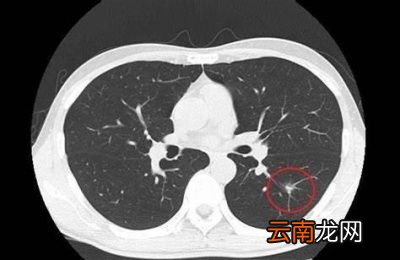 1年做多次肺CT对健康有影响吗