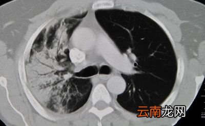 决定多久做一次CT的条件有哪些