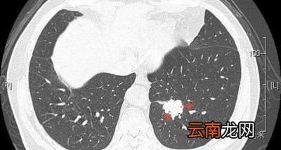 一次胸部CT究竟有多少辐射