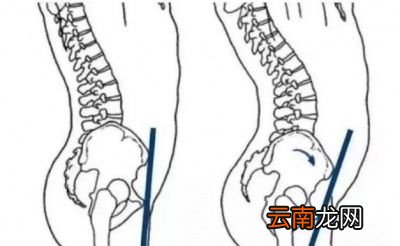 什么是骨盆前倾呢