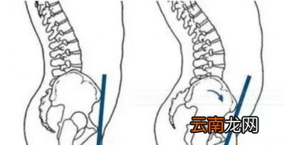 什么是骨盆前倾