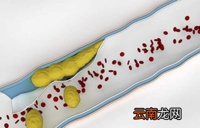 丹参片能清理血管垃圾吗可以长期服用吗
